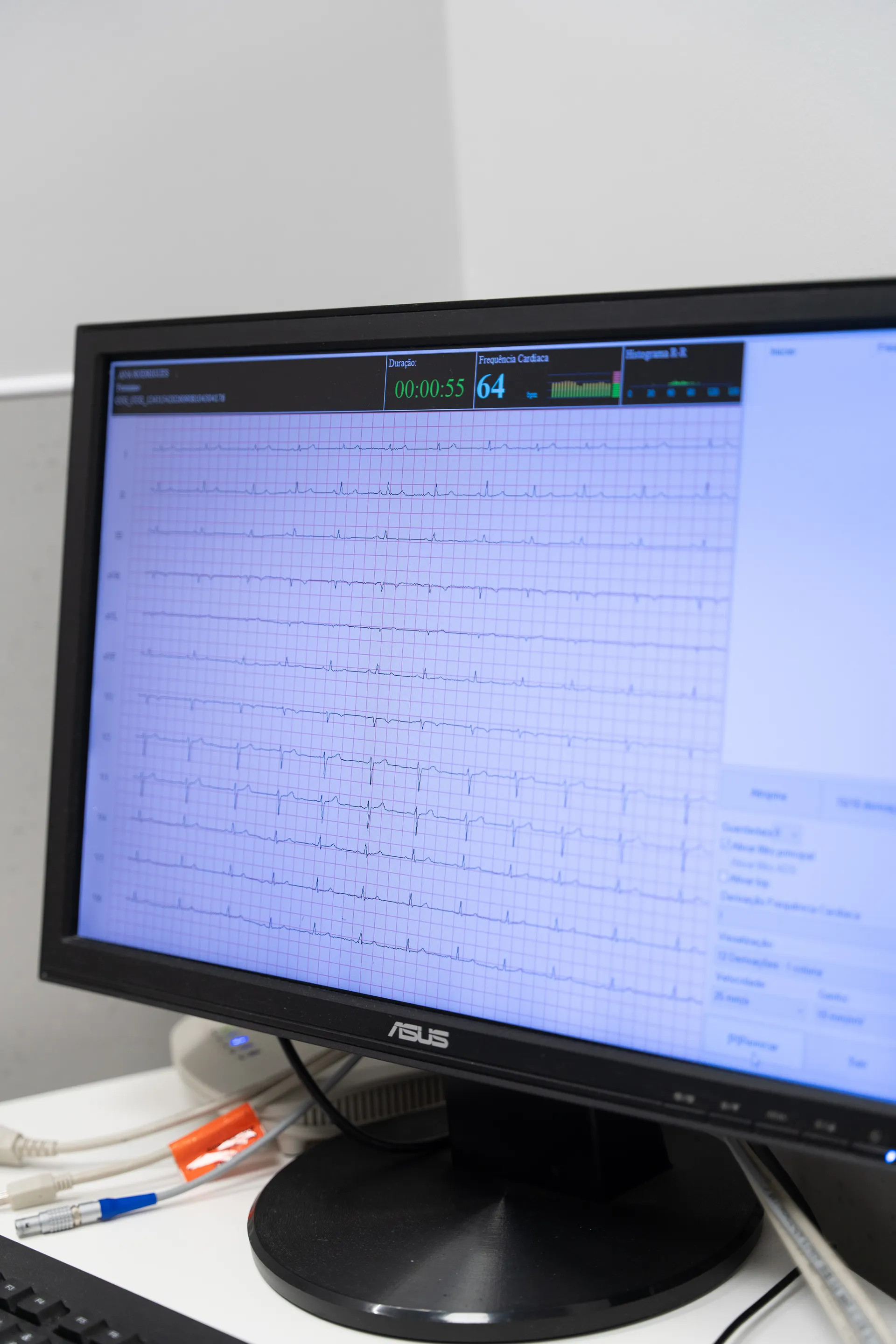 ecg